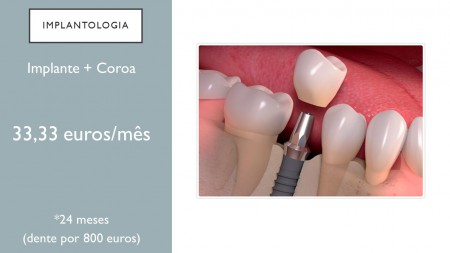 /products/implante-e-coroa/