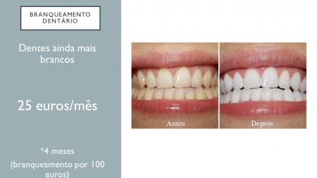 /products/branqueamento-dentario-a-laser1/